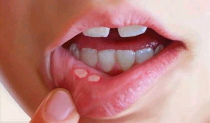 mouth ulcer1